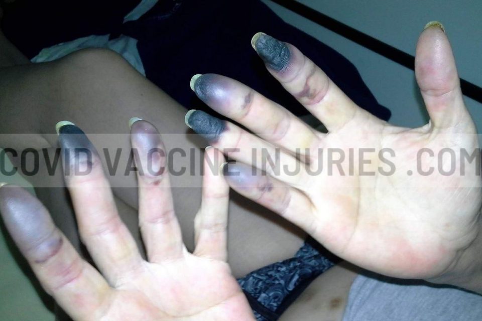 covid vaccine injuries